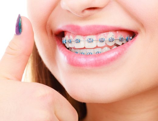 Everything to know before braces instalment singapore