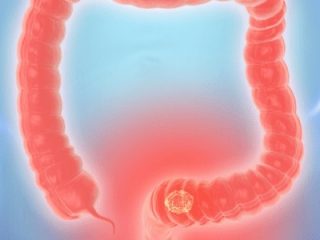 What to know about the Colonoscopy in Singapore?