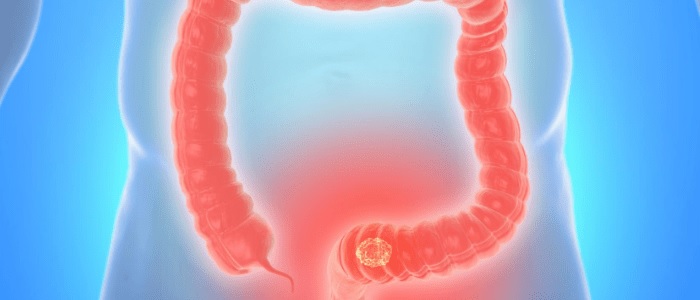 What to know about the Colonoscopy in Singapore?